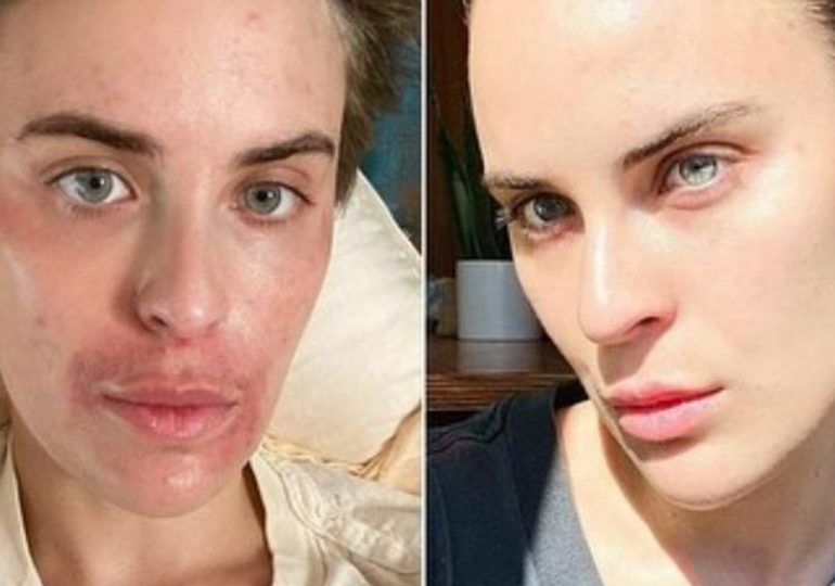 Bruce Willis' daughter shares photos of journey with skin-picking disorder, celebrates 'small wins'